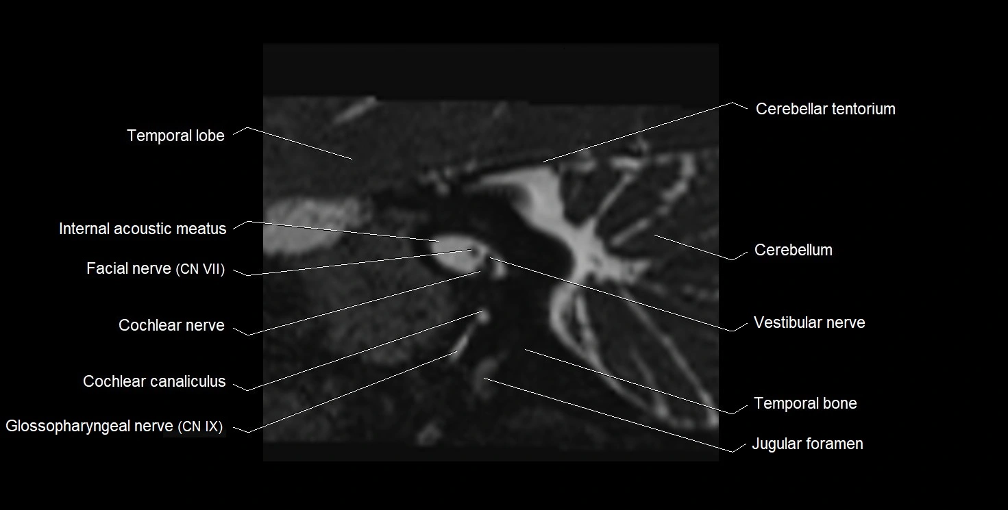 Internal auditory meatus (IAM) 3T sagittal cross sectional anatomy image 23.webp